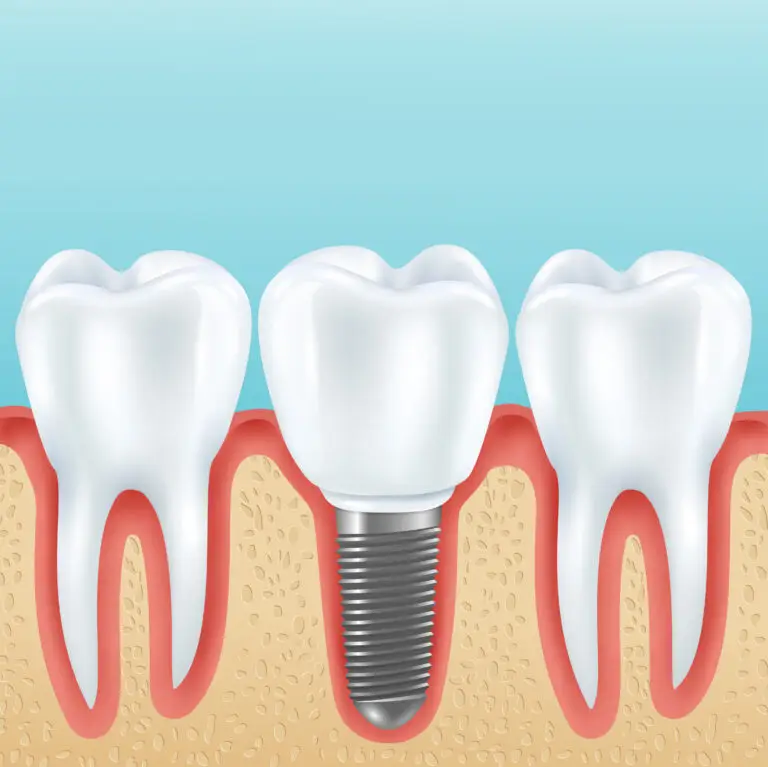 Smilz Dental Implant